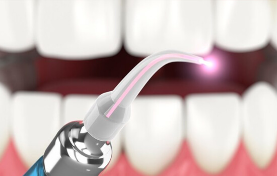 Laser dentistry