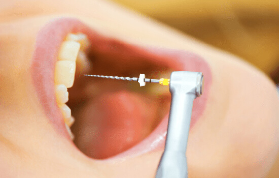 single sitting root canal treatment